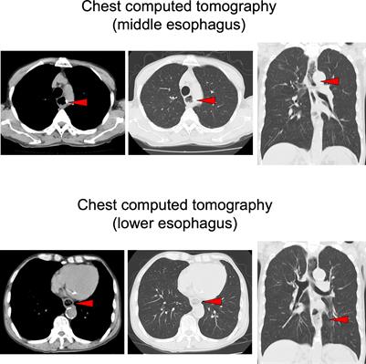 Case Report: Repeated esophageal obstruction in a patient with type 3C diabetes mellitus
